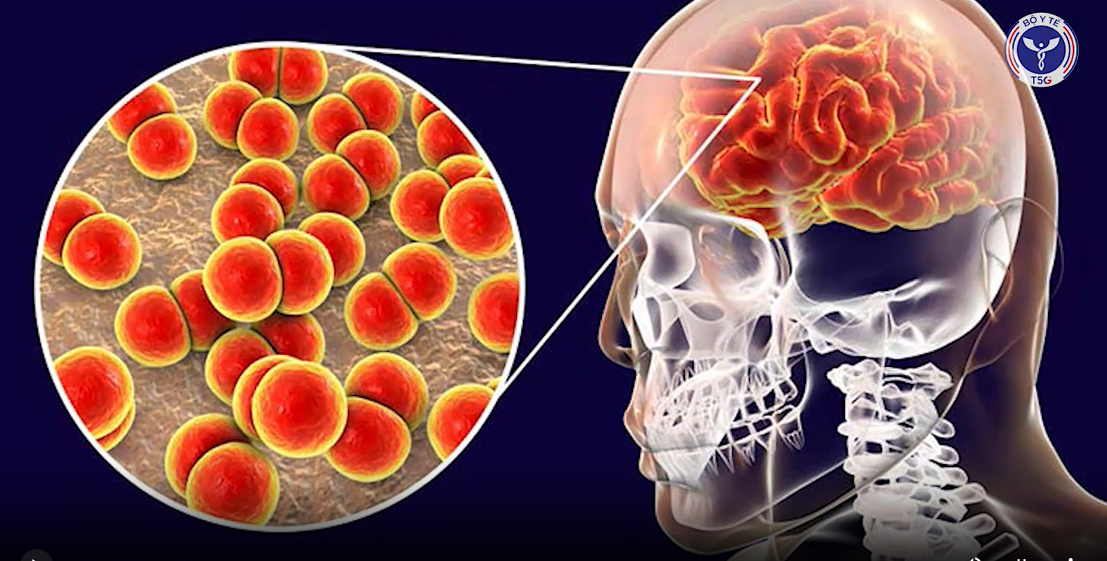 Chủ động phòng ngừa bệnh do não mô cầu xâm lấn